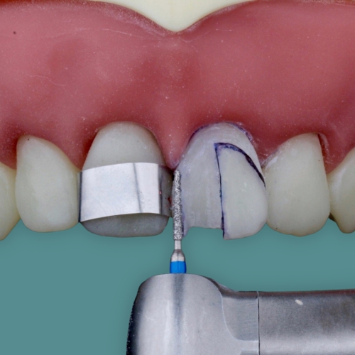 Dente Orais sendo trabalhado com broca em alta rotação
