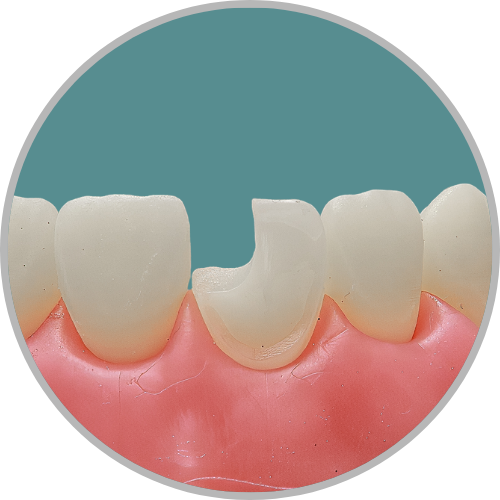 Dente 11 - Classe IV (D) extensa, com preparo para faceta no remanescente (cod:11.A)