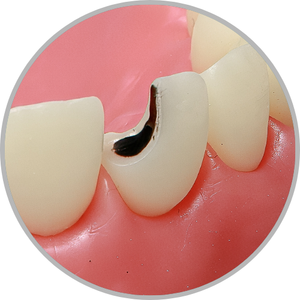 Dente 11 - Lesão de cárie classe IV (M) (cod:11.B)