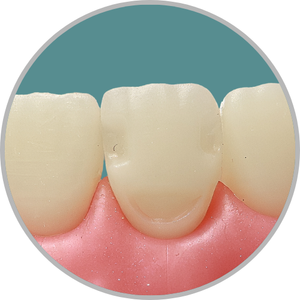 Dente 11 - Classe V (V) e Classe III (D) e (M) (cod:11.C)