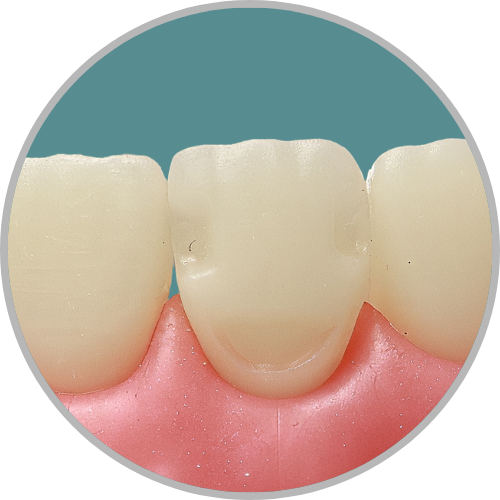 Dente 11 - Classe V (V) e Classe III (D) e (M) (cod:11.C)