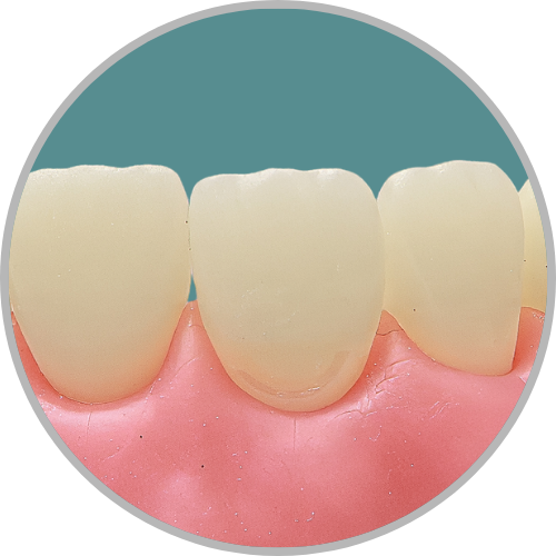 Dente 11 - Classe V(V) (cod:11.D)