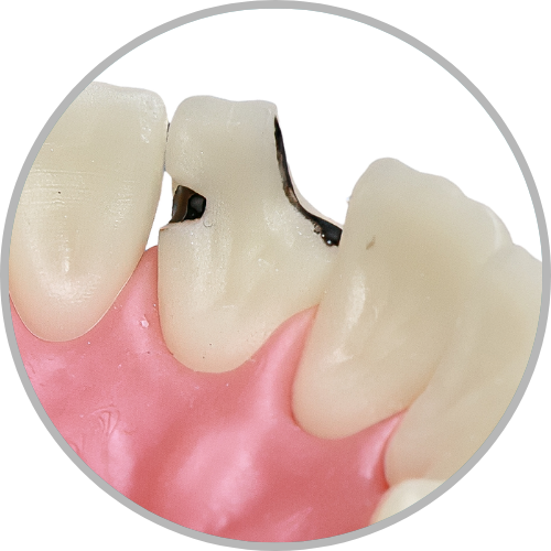 Dente 11 - Lesão de cárie classe III(M) e Lesão de cárie classe IV(D) (cod:11.E)