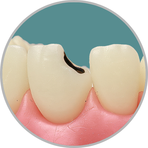 Dente 11 - Lesão de cárie classe IV (D) extensa (cod:11.F)