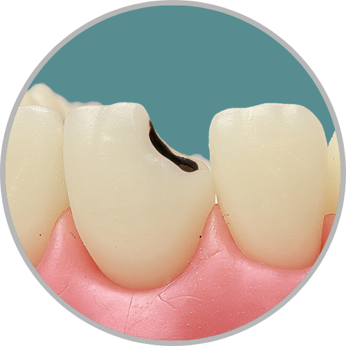 Dente 11 - Lesão de cárie classe IV (D) extensa (cod:11.F)