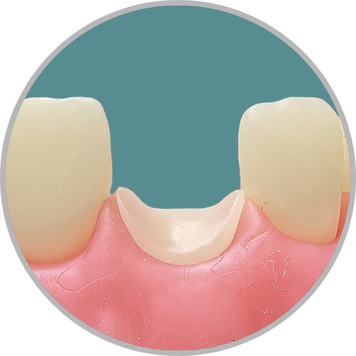 Dente 11 - Coto dental a nível de gengiva (cod:11.I)