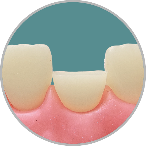 Dente 11 - Coto dental a nível de terço médio (cod:11.J)