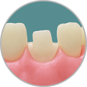 Dente 11 - Coroa Total (cod:11.K)