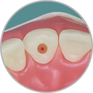 Dente 11 - Fratura no terço médio e conduto preparado (cod:11.L)