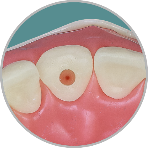 Dente 11 - Fratura no terço médio e conduto preparado (cod:11.L)