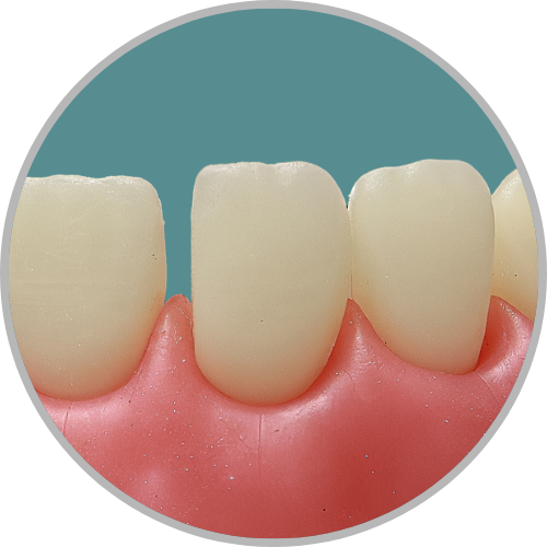 Dente 11 - Diastema mesial (cod:11.M)