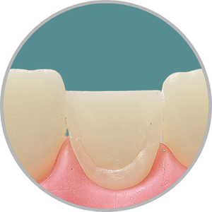 Dente 11 - Preparo para faceta com redução incisal (cod:11.O)
