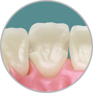 Dente 11 - Cl III MP e DP (cod:11.Q)