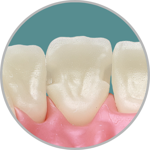 Dente 11 - Cl III MP e DP (cod:11.Q)