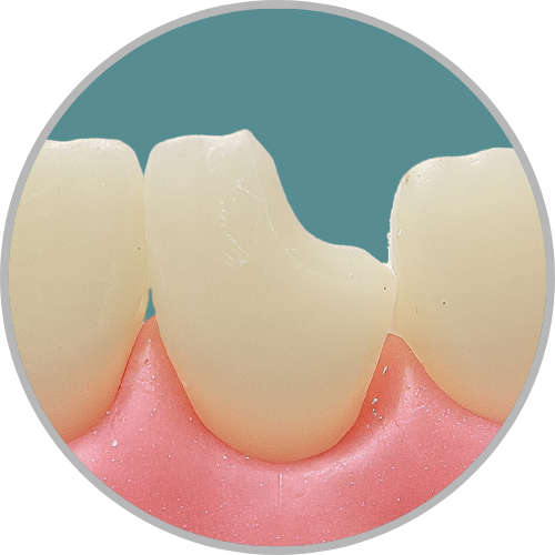 Dente 11 - Classe IV (D) (cod:11.T)