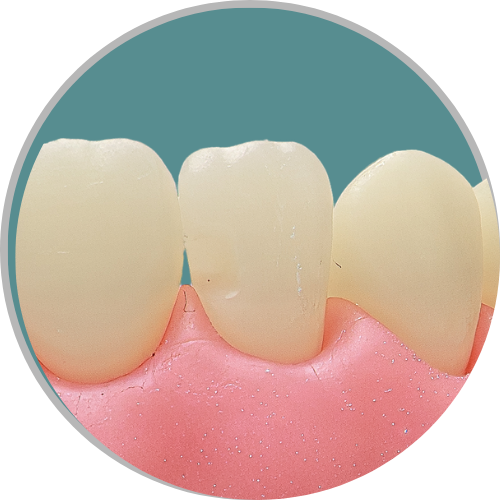 Dente 12 - Classe III (M) (cod:12.A)