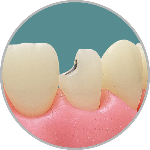 Dente 12 - Lesão de cárie classe IV (M) (cod:12.B)