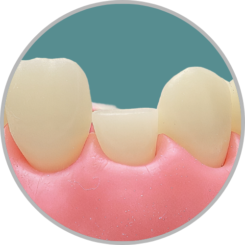 Dente 12 - Coto dental a nivel de terço médio (cod:12.E)