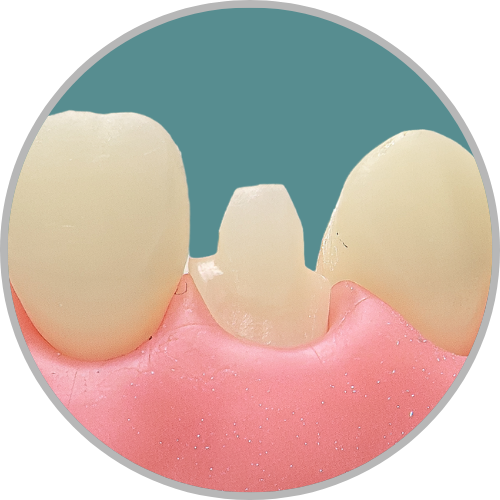 Dente 12 - Coroa Total (cod:12.F)