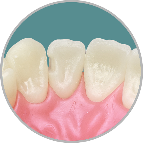Dente 12 - Classe III (D) (cod:12.G)