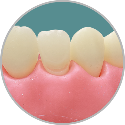 Dente 12 - Classe V (V) (cod:12.H)