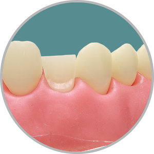 Dente 12 - Preparo para faceta com redução incisal (cod:12.I)
