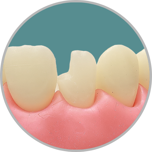 Dente 12 - Classe IV (M) (cod:12.N)