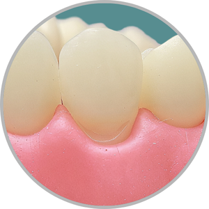 Dente 13 - Classe V (V) (cod:13.B)