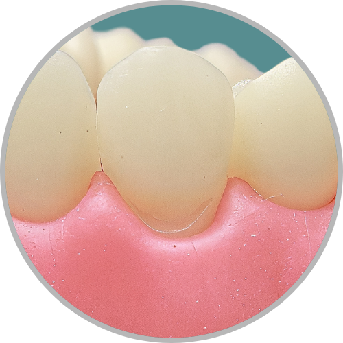 Dente 13 - Classe V (V) (cod:13.B)