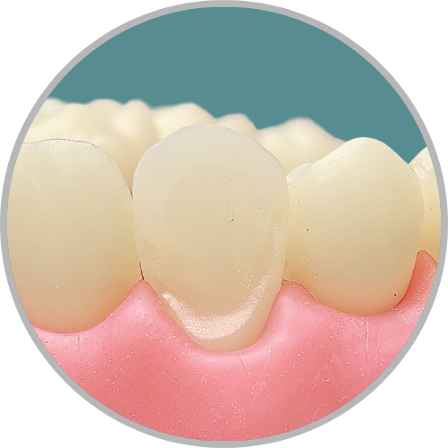 Dente 13 - Preparo para faceta (cod:13.C)