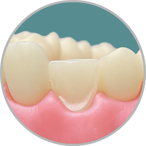 Dente 13 - Perda do terço incisal com preparo para faceta no remanescente (cod:13.D)