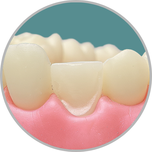 Dente 13 - Perda do terço incisal com preparo para faceta no remanescente (cod:13.D)