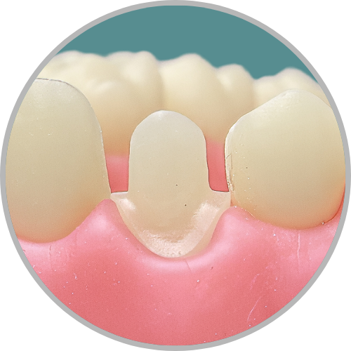 Dente 13 - Coroa Total (cod:13.E)