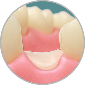 Dente 13 - Coto dental a nível de gengiva (cod:13.G)
