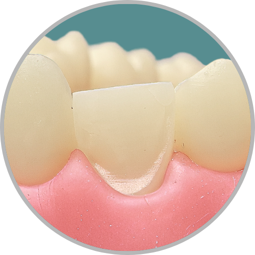 Dente 13 - Preparo para faceta com redução incisal (cod:13.I)