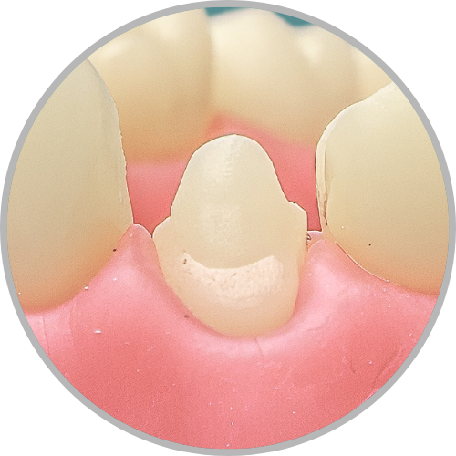 Dente 13 - Anatomia dental / Morfologia (cod:13.J)