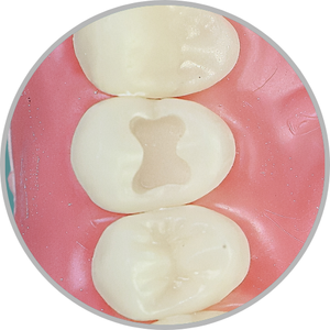 Dente 14 - Classe I (O) (cod:14.A)