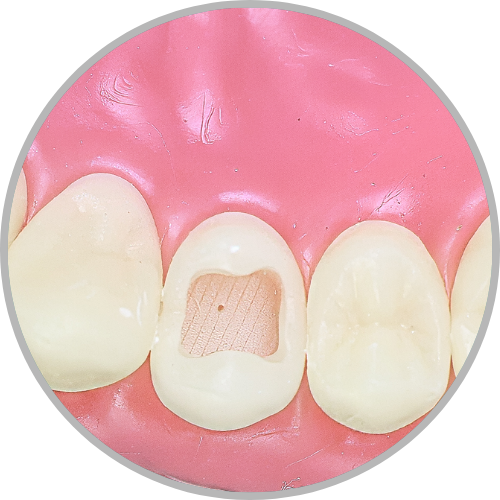 Dente 14 - Classe I (O) larga e profunda (cod:14.C)