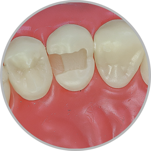 Dente 14 - Classe II (OD) (cod:14.D)