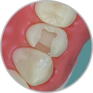 Dente 14 - Classe II (MO) (cod:14.E)