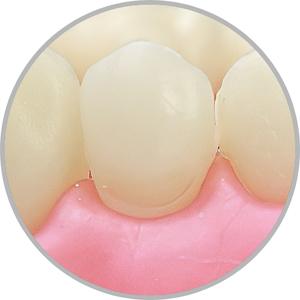 Dente 14 - Classe V (V) (cod:14.G)