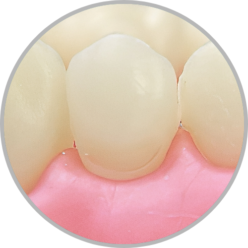 Dente 14 - Classe V (V) (cod:14.G)