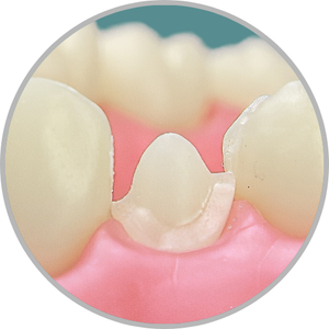 Dente 14 - Coroa Total (cod:14.H)