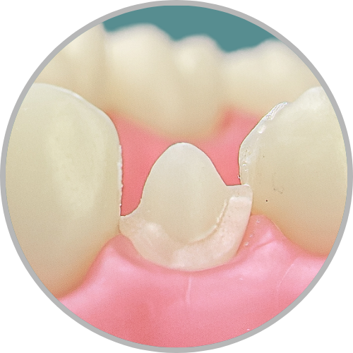 Dente 14 - Coroa Total (cod:14.H)