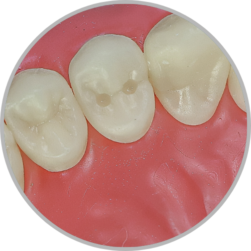 Dente 14 - Clase I em 2 pontos (cod:14.I)