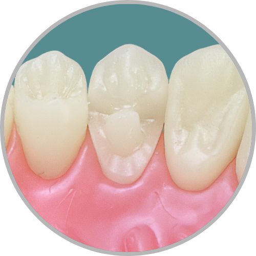 Dente 14 - Onlay (cod:14.J)
