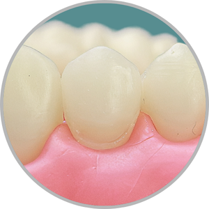 Dente 14 - Faceta do dente 14.K (cod:14.K.1)
