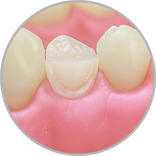Dente 14 - Preparo para faceta com redução incisal (cod:14.K)