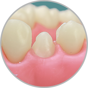 Dente 14 - Anatomia dental / Morfologia (cod:14.L)