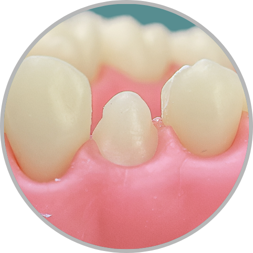 Dente 14 - Anatomia dental / Morfologia (cod:14.L)